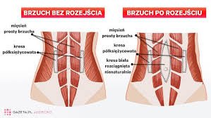 Jak sprawdzić rozstęp mięśnia prostego brzucha ?